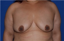 Breast Augmentation Before Photo by Karol Gutowski, MD, FACS; Glenview, IL - Case 39145