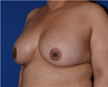 Breast Augmentation After Photo by Karol Gutowski, MD, FACS; Glenview, IL - Case 39145