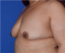 Breast Augmentation Before Photo by Karol Gutowski, MD, FACS; Glenview, IL - Case 39145