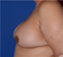 Breast Augmentation After Photo by Karol Gutowski, MD, FACS; Glenview, IL - Case 39145