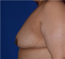 Breast Augmentation Before Photo by Karol Gutowski, MD, FACS; Glenview, IL - Case 39145