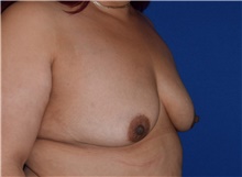 Breast Augmentation Before Photo by Karol Gutowski, MD, FACS; Glenview, IL - Case 39145