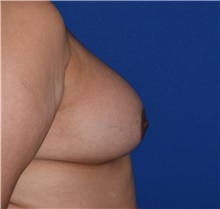 Breast Augmentation After Photo by Karol Gutowski, MD, FACS; Glenview, IL - Case 39145