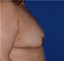 Breast Augmentation Before Photo by Karol Gutowski, MD, FACS; Glenview, IL - Case 39145