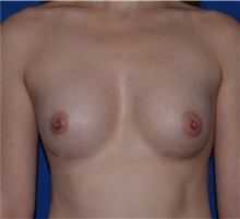 Breast Augmentation After Photo by Karol Gutowski, MD, FACS; Glenview, IL - Case 39147