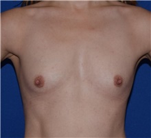 Breast Augmentation Before Photo by Karol Gutowski, MD, FACS; Glenview, IL - Case 39147