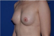 Breast Augmentation After Photo by Karol Gutowski, MD, FACS; Glenview, IL - Case 39147