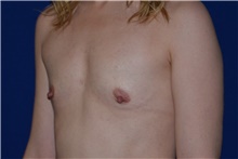 Breast Augmentation Before Photo by Karol Gutowski, MD, FACS; Glenview, IL - Case 39147