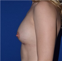 Breast Augmentation After Photo by Karol Gutowski, MD, FACS; Glenview, IL - Case 39147