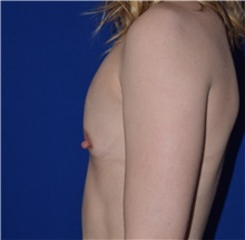 Breast Augmentation Before Photo by Karol Gutowski, MD, FACS; Glenview, IL - Case 39147