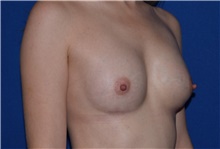 Breast Augmentation After Photo by Karol Gutowski, MD, FACS; Glenview, IL - Case 39147