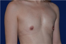 Breast Augmentation Before Photo by Karol Gutowski, MD, FACS; Glenview, IL - Case 39147