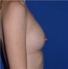 Breast Augmentation After Photo by Karol Gutowski, MD, FACS; Glenview, IL - Case 39147