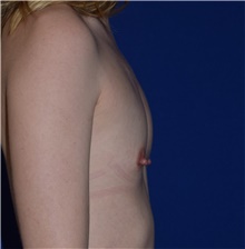 Breast Augmentation Before Photo by Karol Gutowski, MD, FACS; Glenview, IL - Case 39147