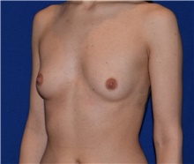 Breast Augmentation Before Photo by Karol Gutowski, MD, FACS; Glenview, IL - Case 39148