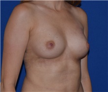 Breast Augmentation Before Photo by Karol Gutowski, MD, FACS; Glenview, IL - Case 39149