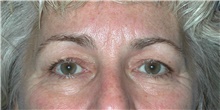 Eyelid Surgery Before Photo by Karol Gutowski, MD, FACS; Glenview, IL - Case 39152