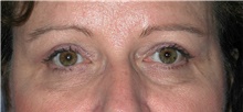 Eyelid Surgery After Photo by Karol Gutowski, MD, FACS; Glenview, IL - Case 39153