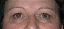 Eyelid Surgery Before Photo by Karol Gutowski, MD, FACS; Glenview, IL - Case 39153