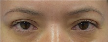 Eyelid Surgery After Photo by Karol Gutowski, MD, FACS; Glenview, IL - Case 39154