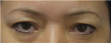 Eyelid Surgery Before Photo by Karol Gutowski, MD, FACS; Glenview, IL - Case 39154