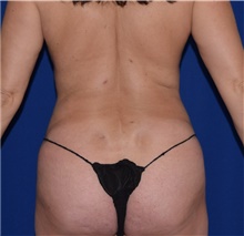 Liposuction After Photo by Karol Gutowski, MD, FACS; Glenview, IL - Case 39157