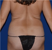 Liposuction Before Photo by Karol Gutowski, MD, FACS; Glenview, IL - Case 39157