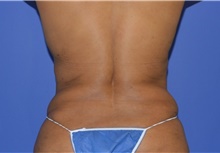 Liposuction After Photo by Karol Gutowski, MD, FACS; Glenview, IL - Case 39158