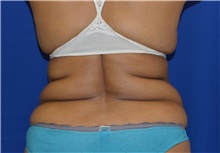 Liposuction Before Photo by Karol Gutowski, MD, FACS; Glenview, IL - Case 39158