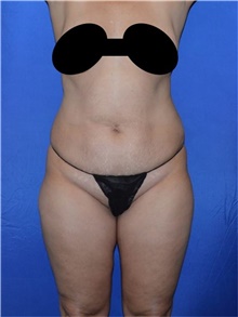 Liposuction Before Photo by Karol Gutowski, MD, FACS; Glenview, IL - Case 39159