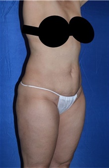 Liposuction After Photo by Karol Gutowski, MD, FACS; Glenview, IL - Case 39159
