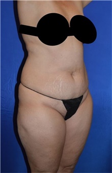 Liposuction Before Photo by Karol Gutowski, MD, FACS; Glenview, IL - Case 39159