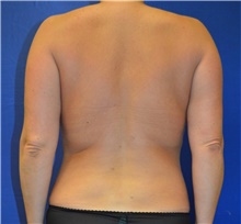 Liposuction After Photo by Karol Gutowski, MD, FACS; Glenview, IL - Case 39160