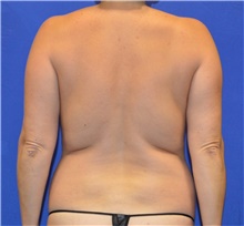 Liposuction Before Photo by Karol Gutowski, MD, FACS; Glenview, IL - Case 39160