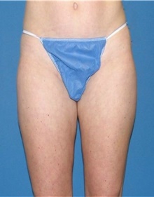 Liposuction After Photo by Karol Gutowski, MD, FACS; Glenview, IL - Case 39162