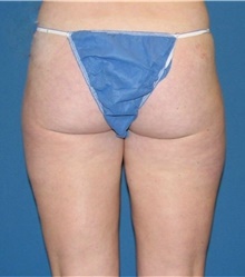 Liposuction After Photo by Karol Gutowski, MD, FACS; Glenview, IL - Case 39162