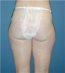 Liposuction Before Photo by Karol Gutowski, MD, FACS; Glenview, IL - Case 39162