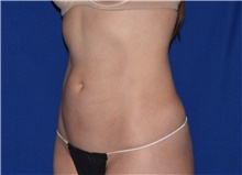 Liposuction After Photo by Karol Gutowski, MD, FACS; Glenview, IL - Case 39163