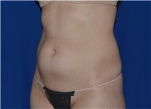 Liposuction Before Photo by Karol Gutowski, MD, FACS; Glenview, IL - Case 39163