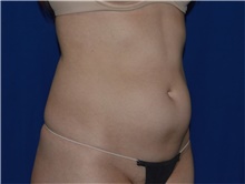 Liposuction Before Photo by Karol Gutowski, MD, FACS; Glenview, IL - Case 39163
