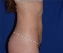Liposuction After Photo by Karol Gutowski, MD, FACS; Glenview, IL - Case 39163