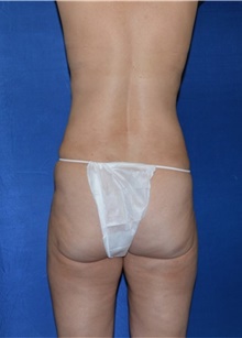 Liposuction After Photo by Karol Gutowski, MD, FACS; Glenview, IL - Case 39164