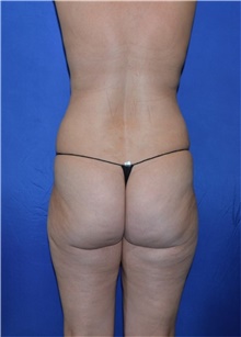 Liposuction Before Photo by Karol Gutowski, MD, FACS; Glenview, IL - Case 39164