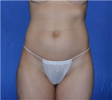 Liposuction Before Photo by Karol Gutowski, MD, FACS; Glenview, IL - Case 39220