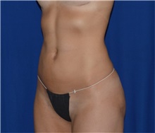 Liposuction After Photo by Karol Gutowski, MD, FACS; Glenview, IL - Case 39220