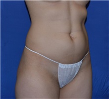 Liposuction Before Photo by Karol Gutowski, MD, FACS; Glenview, IL - Case 39220