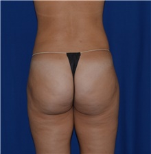 Liposuction After Photo by Karol Gutowski, MD, FACS; Glenview, IL - Case 39220
