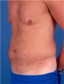 Liposuction Before Photo by Karol Gutowski, MD, FACS; Glenview, IL - Case 39222