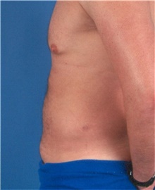 Liposuction After Photo by Karol Gutowski, MD, FACS; Glenview, IL - Case 39222