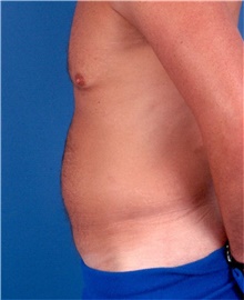 Liposuction Before Photo by Karol Gutowski, MD, FACS; Glenview, IL - Case 39222